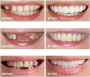 Snap On Smile: Veneers Teeth Whitening Strips Teeth Cover