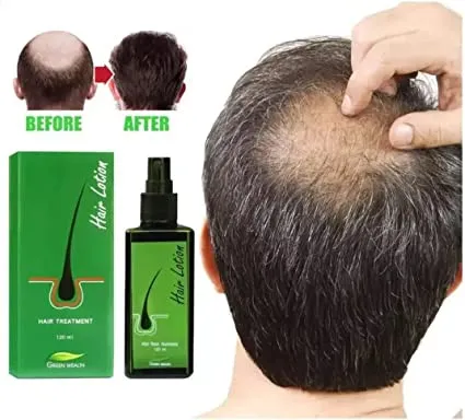 Hair Lotion Hair Treatment, Hair Root Nutrients, Hair Size 120ml